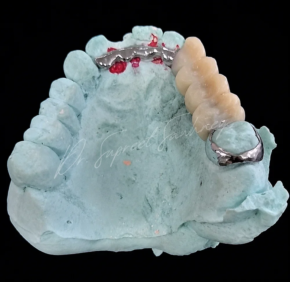 Maxillary working cast showing a metal framework and tooth-coloured prosthetic teeth